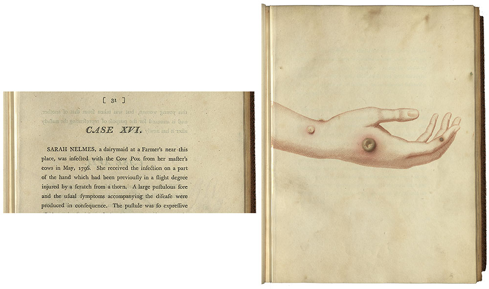 <p>Drawing of the cowpox infection of milkmaid Sarah Nelmes. Jenner used puss from the coxpox infection and gave it to James Phipps before giving him the deadly smallpox infection. He survived the smallpox infection with only mild irritation, proving through experiment that vaccination worked.</p>
